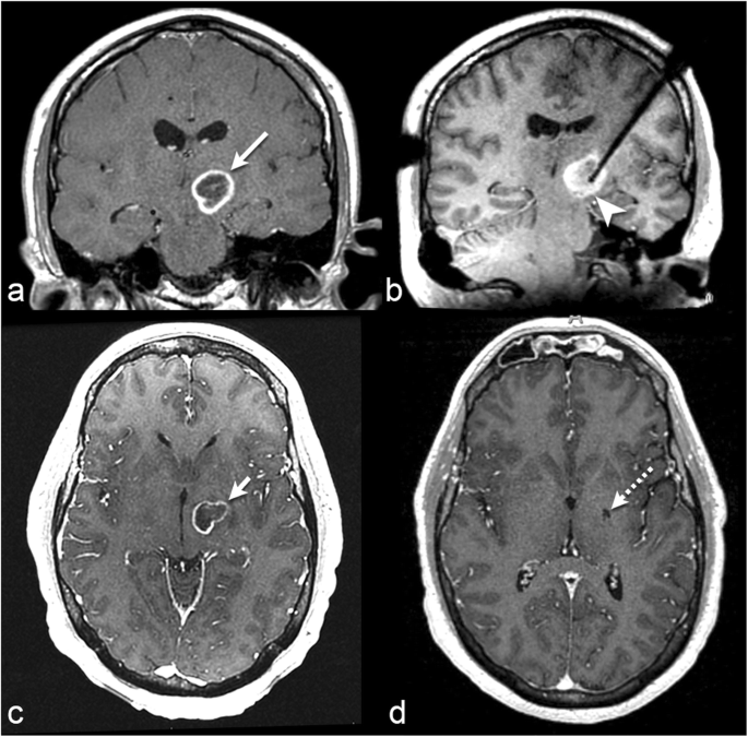 Neurosurgical applications of MRI guided laser interstitial thermal therapy  (LITT) | Cancer Imaging | Full Text