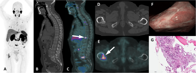 prostate foci fibrosa