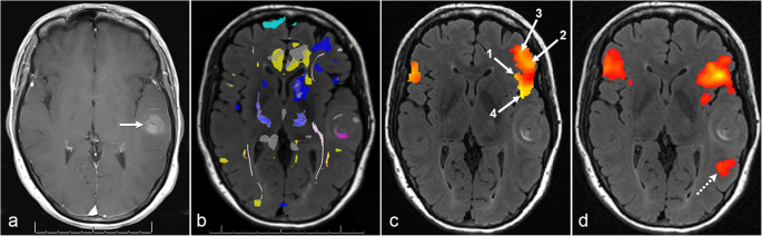 The Role Of Resting State Functional Mri For Clinical Preoperative Language Mapping Cancer Imaging Full Text