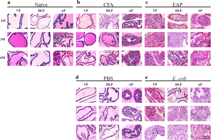 Prostatitis és hemoglobin difference between prostate and bowel cancer