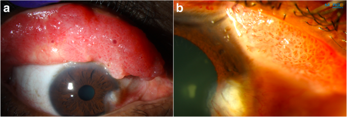 papilloma vírus tunetei papilloma vírus nyállal