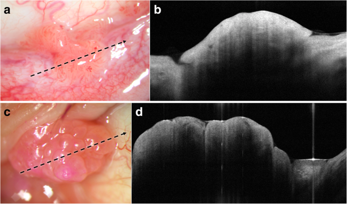 Papilloma conjunctiva treatment