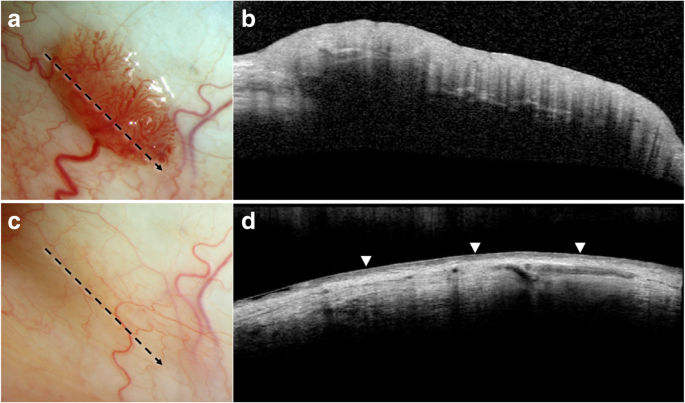 Boca papiloma virus