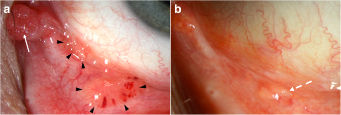 papillomas occur mainly in which group)