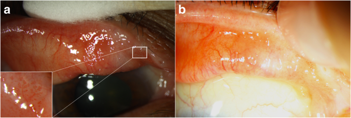 a papilloma vírus oka