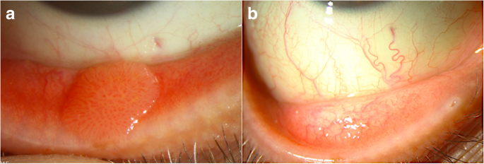 conjunctival papilloma definition)
