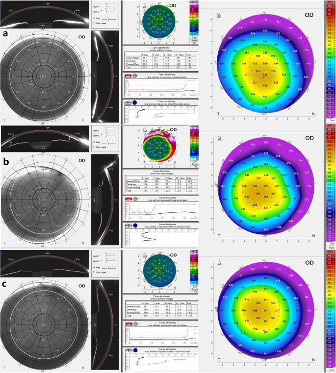 werkgelegenheid Imitatie Caroline Investigation of corneal topographic and densitometric properties of Wilson's disease patients with or without a Kayser-Fleischer ring | Eye and Vision | Full Text werkgelegenheid Imitatie Caroline Investigation of corneal topographic and densitometric properties of Wilson's disease patients with or without a Kayser-Fleischer ring | Eye and Vision | Full Text