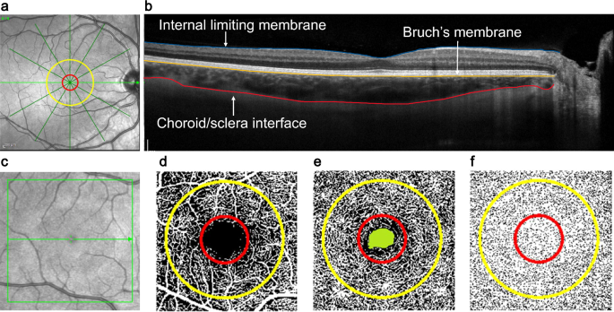 低用量アトロピン点眼薬による近視制御（Low-dose atropine eye drops manage myopia）