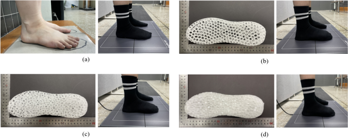 Analysis of plantar pressure of midsole prepared by 3d printed  