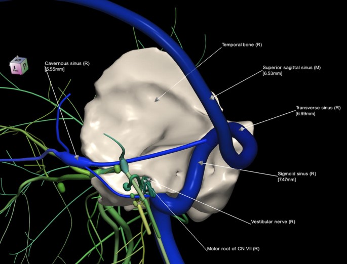 A 3d Stereotactic Atlas Of The Adult Human Skull Base Springerlink