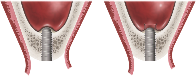 Influence of exposing dental implants into the sinus cavity on survival and  complications rate: a systematic review | International Journal of Implant  Dentistry | Full Text