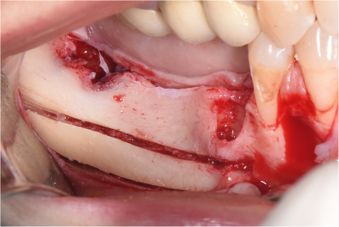 Mandibular nerve dental surgery