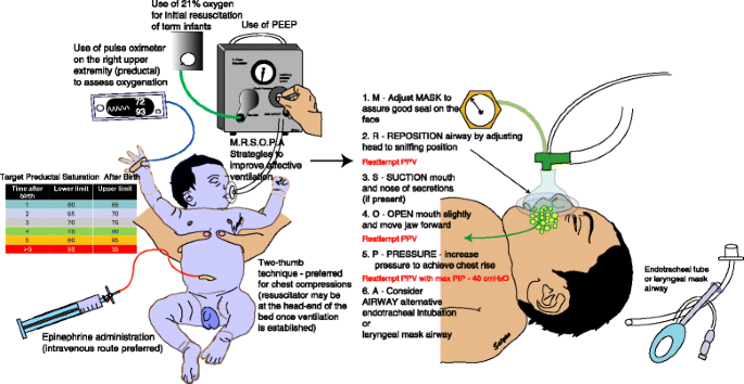 Neonatal resuscitation: evolving strategies | Maternal Health, Neonatology  and Perinatology | Full Text