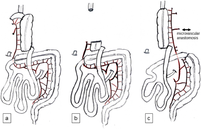 Secondary reconstruction with a transverse colon covered with a pectoralis  major muscle flap and split thickness skin grafts for an esophageal defect  and wide skin defects of the anterior chest wall