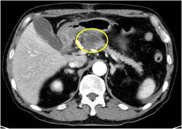Successful Surgical Internal Drainage Of Postoperative Pancreatic Pseudocyst Through Pancreaticojejunostomy With Distal Pancreatectomy A Case Report Surgical Case Reports Full Text