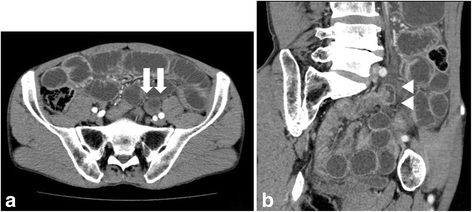 Strangulation of the small intestine caused by an intra-mesosigmoid hernia:  a case report | Surgical Case Reports | Full Text