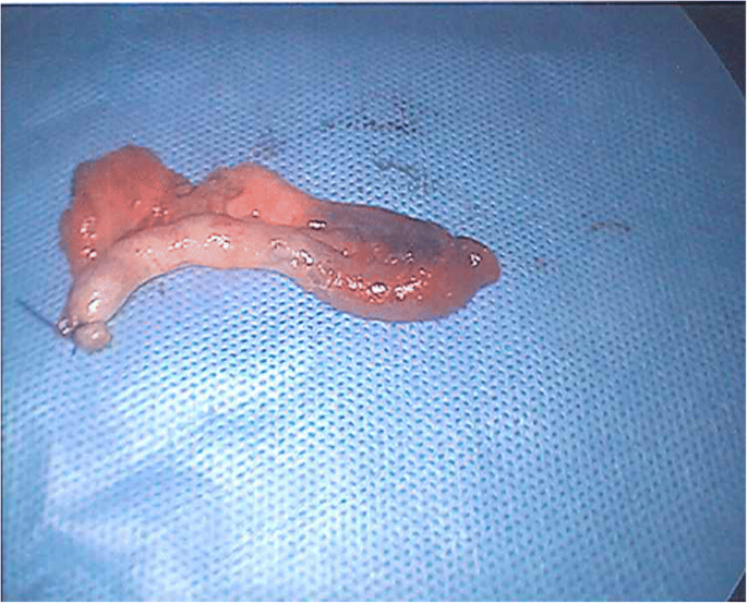A rare presentation of appendicitis inside the femoral canal: case report  and literature review | Surgical Case Reports | Full Text
