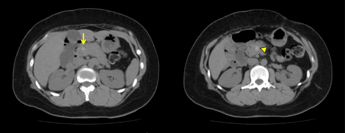 Pancreaticobiliary maljunction diagnosed long after laparotomy in the  neonatal period for annular pancreas: report of a case | Surgical Case  Reports | Full Text