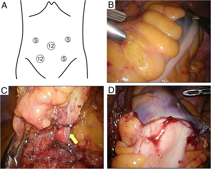 reoid cancer laparoscopic paraziti u crevima lecenje