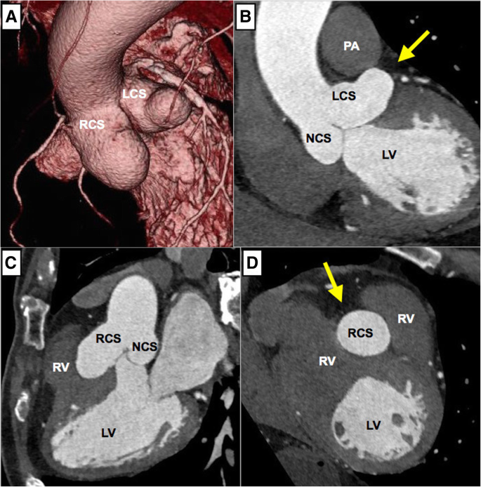 A Rare Case Of Unruptured Extracardiac Multiple Sinus Of Valsalva Aneurysms Originating From The Orifices With Partial Aortic Wall Defects Surgical Case Reports Full Text
