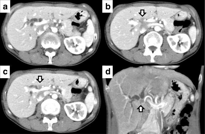 ovarian cancer jaundice