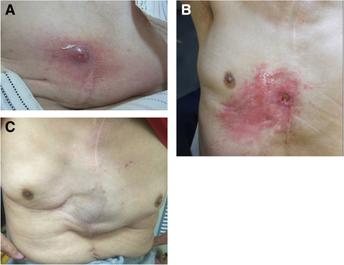 Refractory Cutaneo Gastric Conduit Fistula After Esophagectomy Repaired By A Pectoralis Major Muscle Flap And Split Thickness Skin Graft Surgical Case Reports Full Text