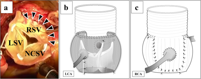 Florida Sleeve Technique For A Right Sinus Of Valsalva Aneurysm A Case Report Surgical Case Reports Full Text Florida Sleeve Technique For A Right Sinus Of Valsalva Aneurysm A Case Report Surgical Case Reports Full Text