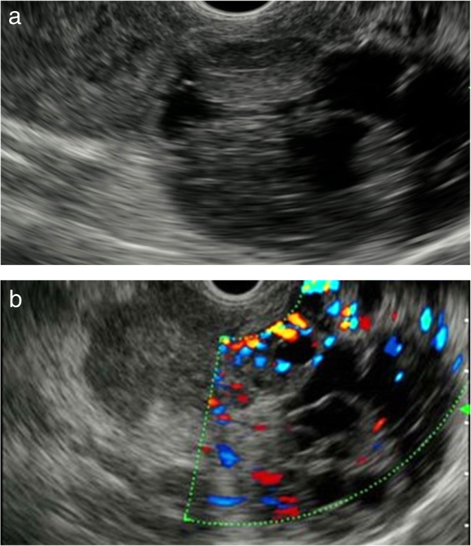 Cytopathological characteristics of solitary fibrous tumour involving the  pancreas by fine needle aspiration: Making an accurate preoperative  diagnosis in an uncommon location - Jones - 2022 - Cytopathology - Wiley  Online Library