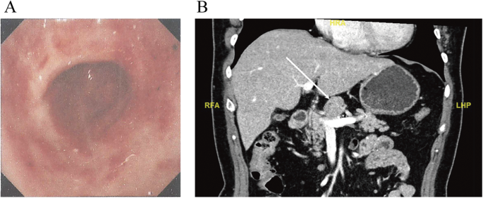 abdominal cancer nodules