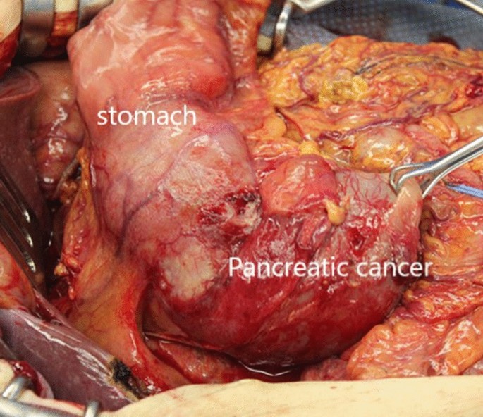 pancreas cancer