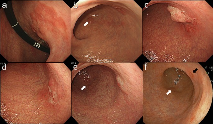cancer of gastric antrum picături din viermi