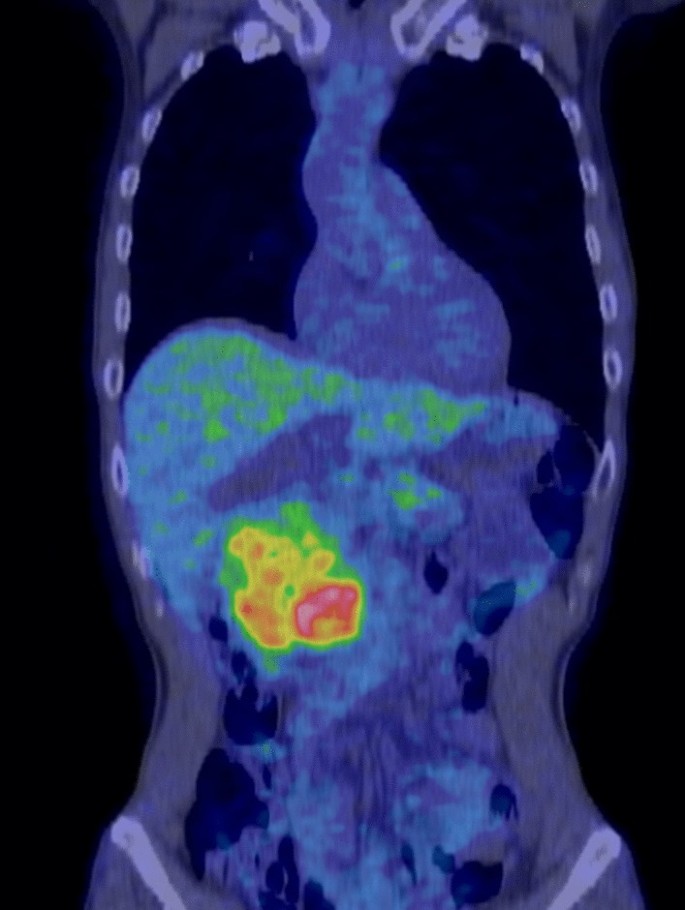 Cytopathological characteristics of solitary fibrous tumour involving the  pancreas by fine needle aspiration: Making an accurate preoperative  diagnosis in an uncommon location - Jones - 2022 - Cytopathology - Wiley  Online Library