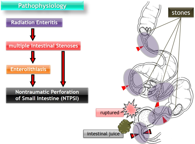 Causes Of Jejunal Perforation