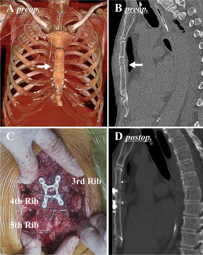 Average Compensation For Fractured Sternum Temple City thumbnail
