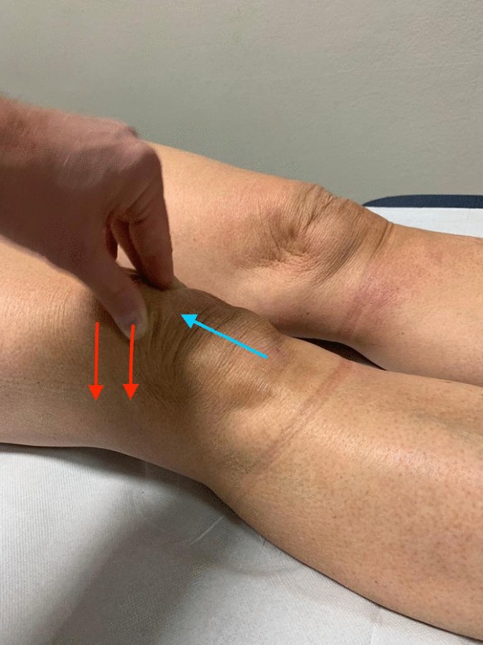 Example of patellar orientation with a lateral glide and/or tilt