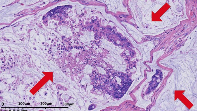 adenocarcinoma colon histology