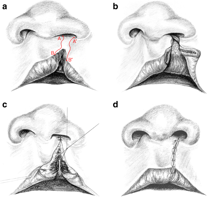 Postoperative long-term results for the comparison of the symmetry of the  upper lip during lip closure according to Millard and Pfeifer |  Maxillofacial Plastic and Reconstructive Surgery | Full Text