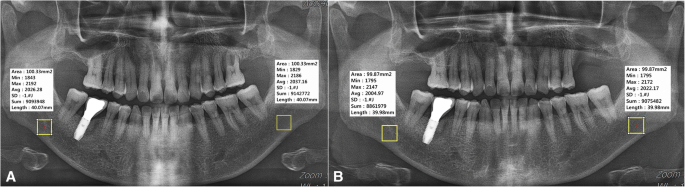 osteomyelitis x ray jaw