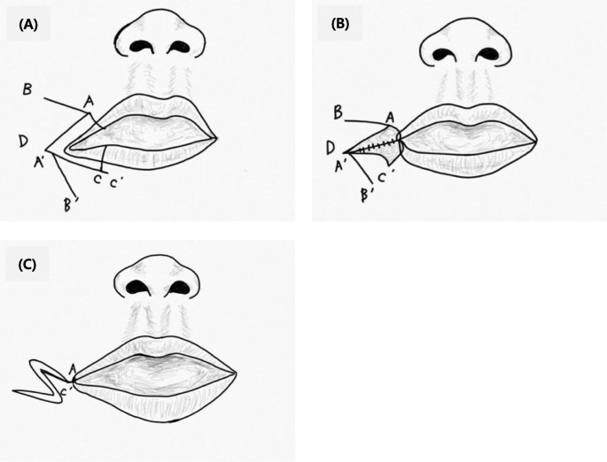 transverse facial cleft