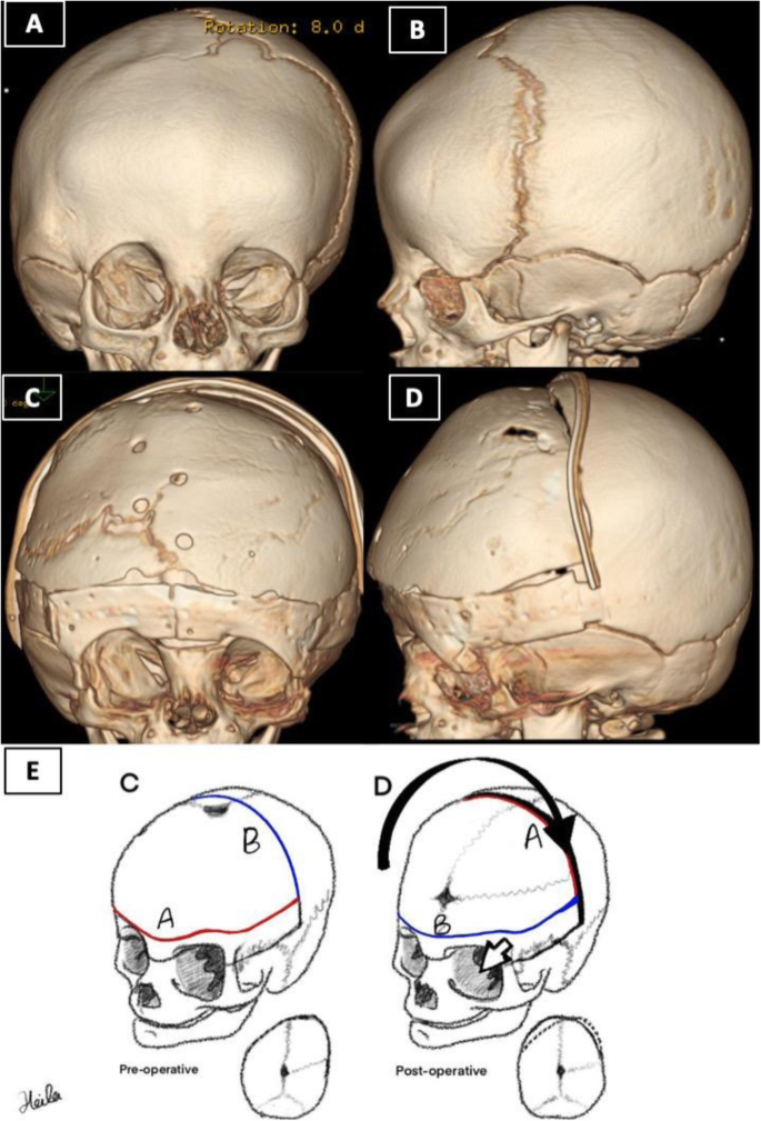 Aesthetic Skull Reshaping