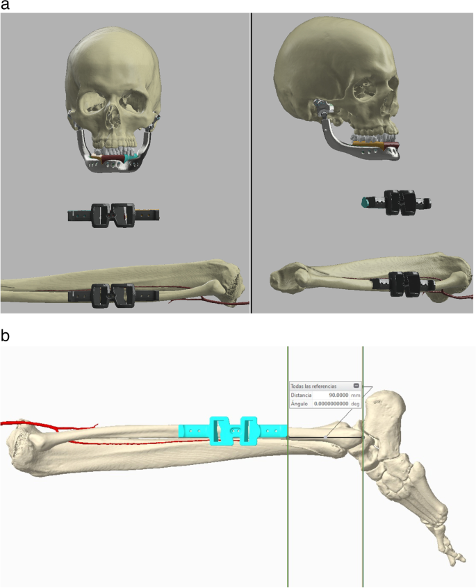 Total jaw implant