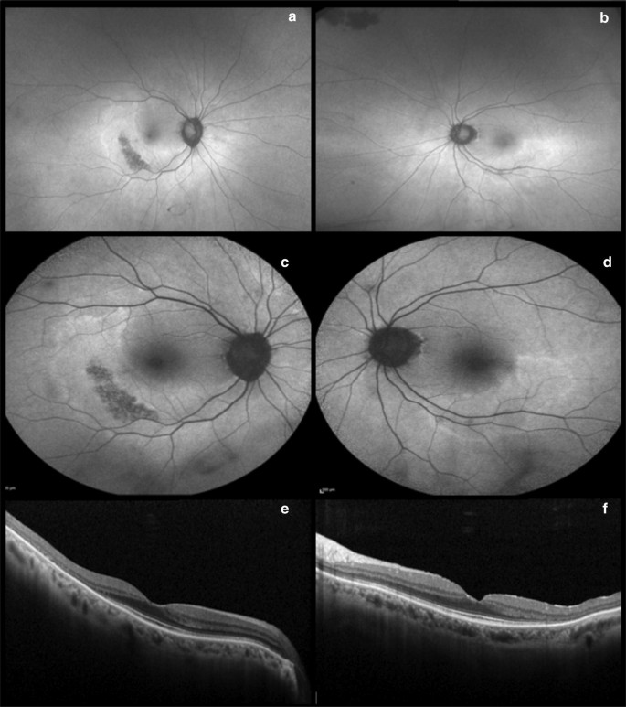 Wide Field Retinal Imaging And The Detection Of Drug Associated