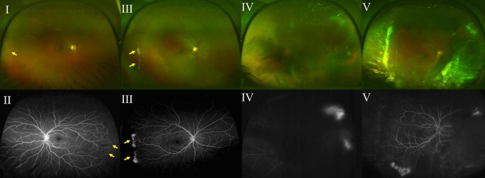 sickle cell retinopathy sea fan