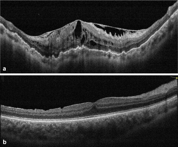 Evaluation Of Primary Internal Limiting Membrane Peeling In Cases With Rhegmatogenous Retinal Detachment International Journal Of Retina And Vitreous Full Text