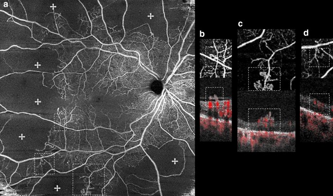 Optical Coherence Tomography Features Of Neovascularization In Proliferative Diabetic Retinopathy A Systematic Review International Journal Of Retina And Vitreous Full Text