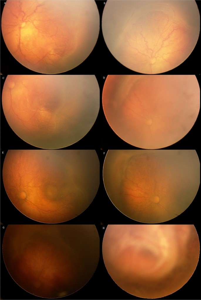 Ocular complications following intravitreal bevacizumab injection for  retinopathy of prematurity and assessment of risk factors | International  Journal of Retina and Vitreous | Full Text