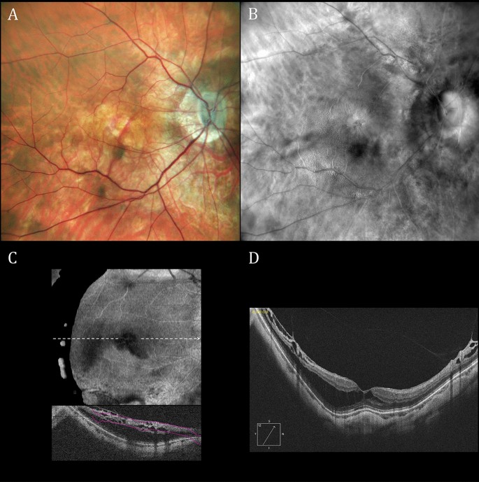 Scanning laser ophthalmoscopy retroillumination: applications and illusions  | International Journal of Retina and Vitreous | Full Text