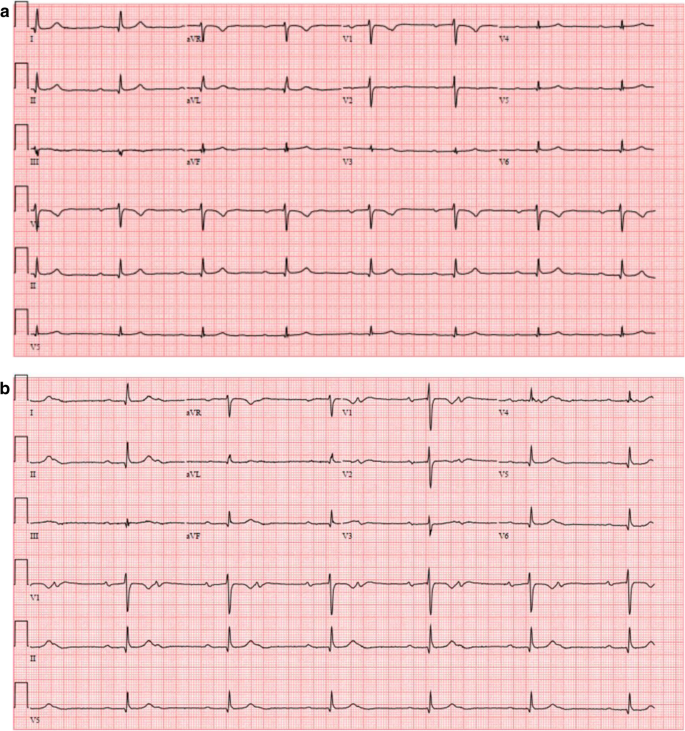 A Case Of Irreversible Bradycardia After Rituximab Therapy For Diffuse Large B Cell Lymphoma Cardio Oncology Full Text