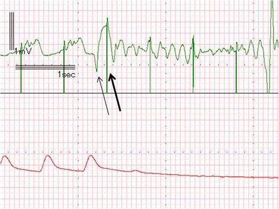 Reiterative ventricular fibrillation caused by R-on-T during temporary  epicardial pacing: a case report | JA Clinical Reports | Full Text