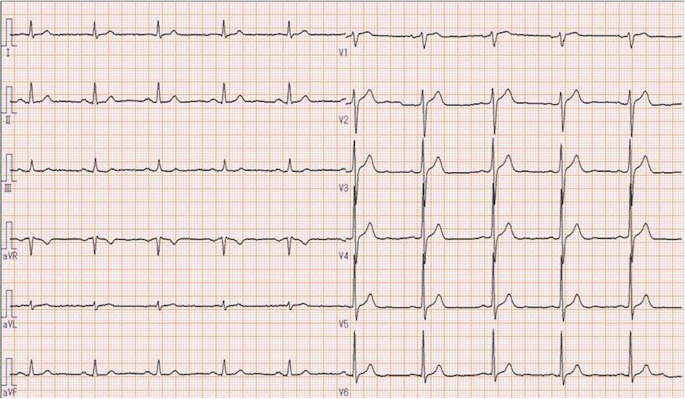 Ventricular tachycardia without preceding electrocardiogram change after  hypertonic mannitol administration: a case report | JA Clinical Reports |  Full Text